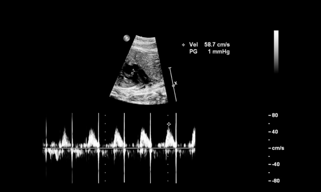 Stress Echocardiography Test Lucknow